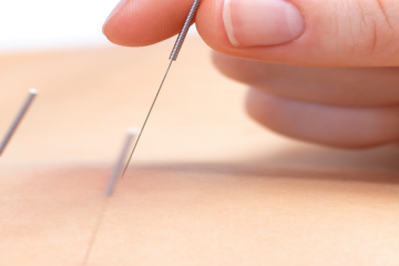 Dryneedling